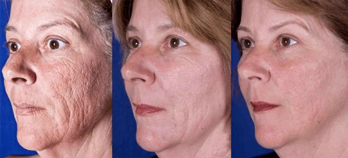 लेजर चेहरे की त्वचा कायाकल्प प्रक्रिया के बाद परिणाम